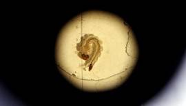 Detectado el primer caso en Espaa de un feto con microcefalia por zika