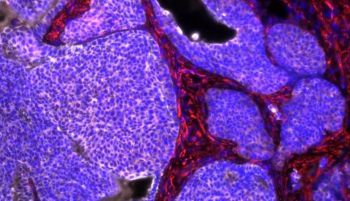 Científicos españoles identifican las células responsables de la recaída en el cáncer de colon
