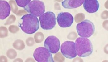 Un fármaco experimental hace remitir la leucemia aguda en 18 pacientes