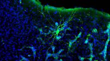 Descubren que los tumores cerebrales ‘hackean’ las conexiones entre neuronas