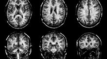 Visualizan con más claridad el daño de la esclerosis múltiple en el cerebro