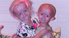 Nueve investigadores se unen para definir la progeria
