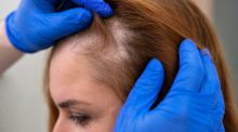 Alopecia femenina: una conexión entre genes aumenta el riesgo