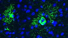 Vinculan el exceso de una proteína con el desarrollo temprano del alzhéimer