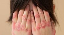 Hacia un nuevo tratamiento terapéutico para la psoriasis