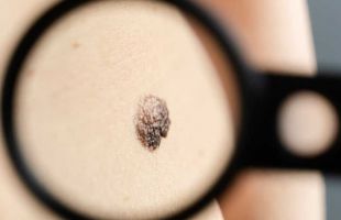 Melanoma: ¿cómo se produce la metástasis ósea?