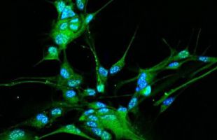 Visualizan cómo se multiplican las células cancerosas en el glioblastoma