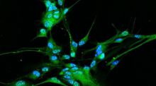 Visualizan cómo se multiplican las células cancerosas en el glioblastoma