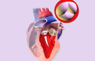 Vinculan estenosis aórtica con resistencia a la insulina