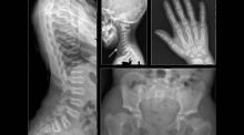 Desvelado el misterio de una rara enfermedad ósea