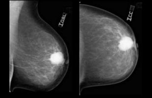 Logran erradicar en el laboratorio la recaída del cáncer de mama más agresivo