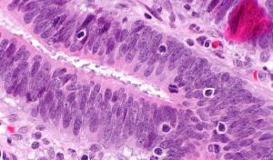 Una vacuna da resultados esperanzadores en cáncer de páncreas y colorrectal
