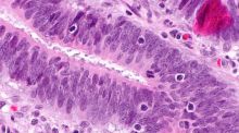 Una vacuna da resultados esperanzadores en cáncer de páncreas y colorrectal