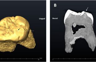 Desvelan que los neandertales utilizaban su dentadura como 'una tercera mano'