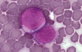 ¿Cómo engaña la leucemia al sistema inmunitario?