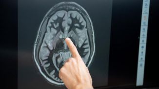 Observan cómo la tirzepatida reduce el “ruido alimentario” en el cerebro