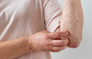 La OMS retira a España el estatus de país libre de sarampión