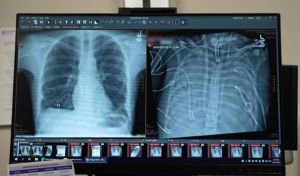 Un paciente sobrevive 48 horas sin pulmones gracias a un 'pulmón artificial'