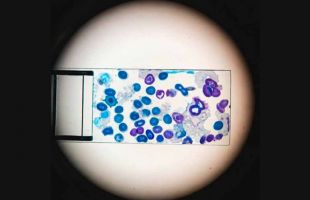 Descubren cómo la leucemia engaña al sistema inmunitario