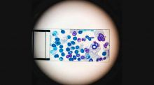 Descubren cómo la leucemia engaña al sistema inmunitario