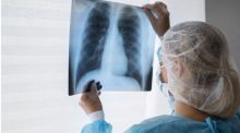 La tuberculosis repunta un 8,3% en un año: síntomas, transmisión y tratamiento