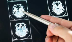 Desarrollan una plataforma que detecta el alzhéimer de forma precoz a través de la voz