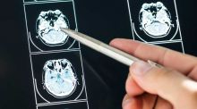 Desarrollan una plataforma que detecta el alzhéimer de forma precoz a través de la voz