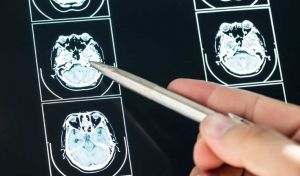 Investigadores españoles prueban una nueva cirugía para el alzhéimer en fase inicial
