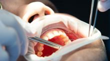 Eliminan con ultrasonidos células cancerosas de la boca