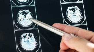 Un 'error de limpieza', posible causa tras enfermedades como alzhéimer o ELA